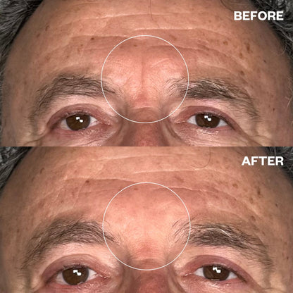 Wrinkles Schminkles Men's Pro Forehead Wrinkle Patch - 1 Patch