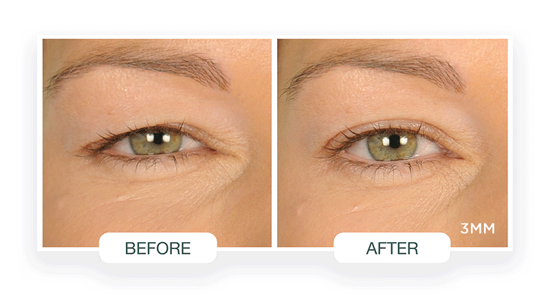 Contours Rx Lids by Design 5mm Eye Lift Strips - 80 Pack