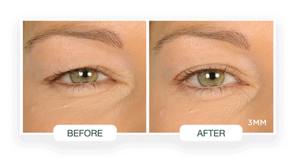 Contours Rx Lids by Design 5mm Eye Lift Strips - 80 Pack