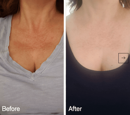 Omnilux Contour Neck & Décolleté