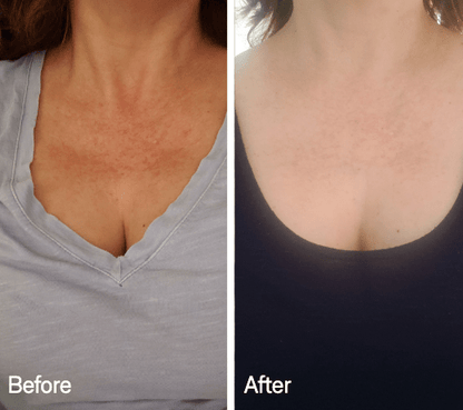 Omnilux Contour Neck & Décolleté