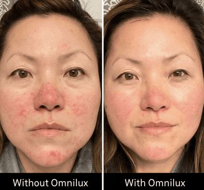 Omnilux Contour Face