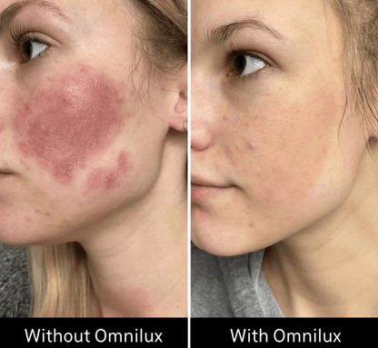 Omnilux Contour Face