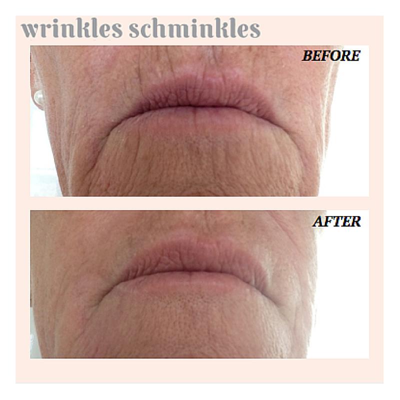 Wrinkles Schminkles Mouth and Lip Smoothing Kit